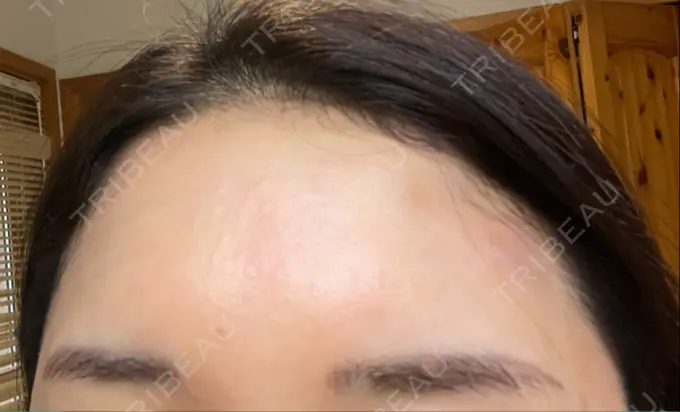 ボトックス（エラ・小顔） / ボトックス（額） TCB東京中央美容外科 仙台駅前院 AFTER メイン用