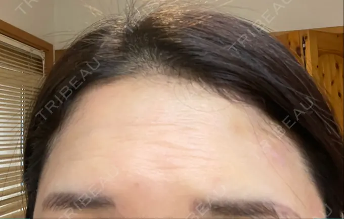 ボトックス（エラ・小顔） / ボトックス（額） TCB東京中央美容外科 仙台駅前院 DAY 2 メイン用