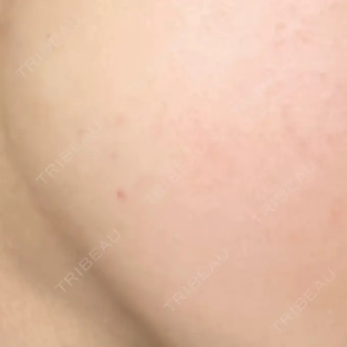 ボトックス（エラ・小顔） / ボトックス（額） TCB東京中央美容外科 仙台駅前院 DAY 2 メイン用