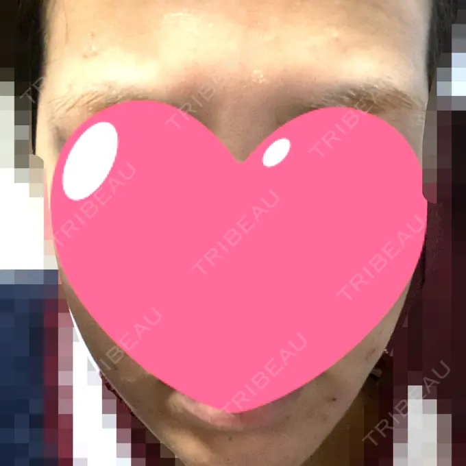 ピーリング（ニキビ・毛穴） / ピコレーザートーニング（美白・肝斑） / ピーリング（ハリ・ツヤ） / ニキビ治療 ルラ美容クリニック 高田馬場院 AFTER メイン用