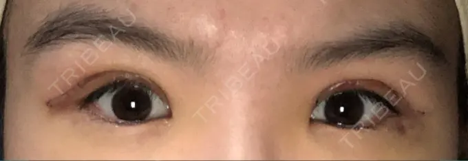 二重切開 / 上まぶたの脂肪取り ブリスクリニック形成外科・美容外科・美容皮膚科 福岡 DAY 4 メイン用