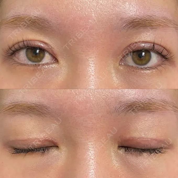 二重切開 / 上まぶたたるみ取り みずほクリニック DAY 14 メイン用