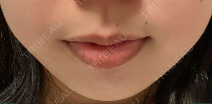 ボトックス（口角） Olino美容外科・美容皮膚科 AFTER メイン用