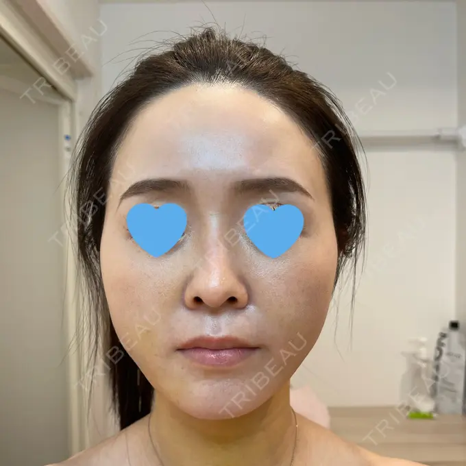 糸リフト / 脂肪吸引（顔） / メーラーファット除去 / ジョールファット除去 / ボトックス（エラ・小顔） 湘南美容クリニック 秋葉原院 DAY 8 メイン用