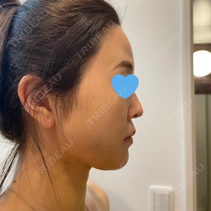 糸リフト / 脂肪吸引（顔） / メーラーファット除去 / ジョールファット除去 / ボトックス（エラ・小顔） 湘南美容クリニック 秋葉原院 DAY 8 メイン用