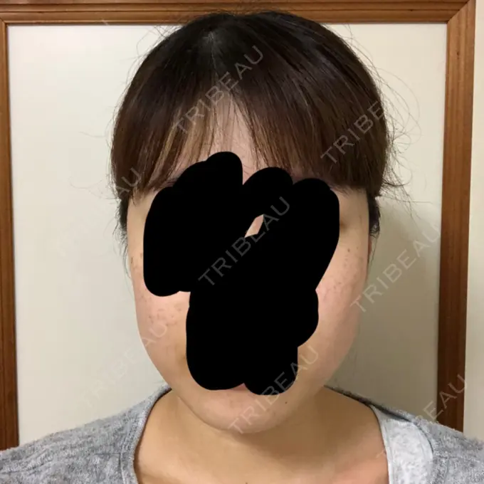 ボトックス（エラ・小顔） 湘南美容クリニック 名古屋栄院 DAY 2 メイン用