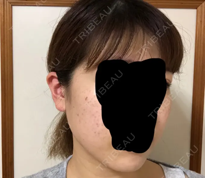 ボトックス（エラ・小顔） 湘南美容クリニック 名古屋栄院 DAY 2 メイン用