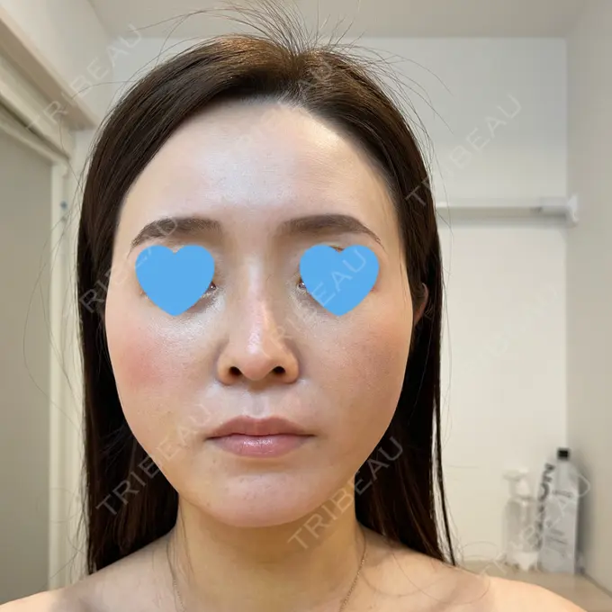 糸リフト / 脂肪吸引（顔） / メーラーファット除去 / ジョールファット除去 / ボトックス（エラ・小顔） 湘南美容クリニック 秋葉原院 DAY 9 メイン用