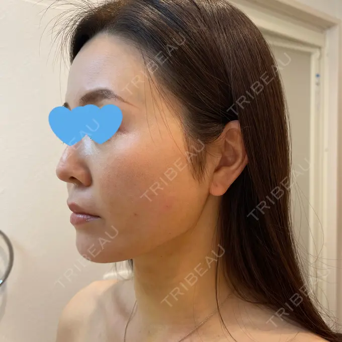 糸リフト / 脂肪吸引（顔） / メーラーファット除去 / ジョールファット除去 / ボトックス（エラ・小顔） 湘南美容クリニック 秋葉原院 DAY 9 メイン用