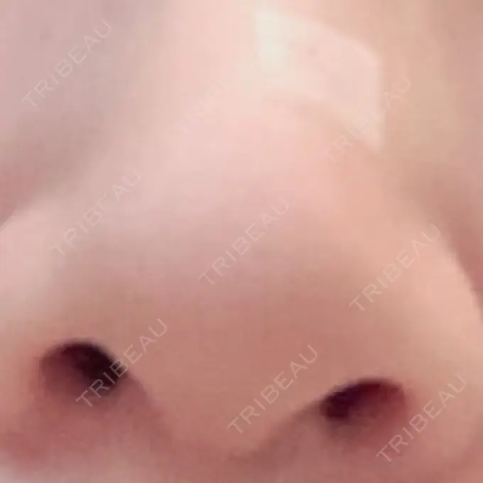 ほくろ・いぼ切除（肌） 吉祥寺アイビークリニック DAY 0 メイン用