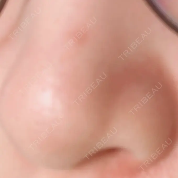 ほくろ・いぼ切除（肌） 吉祥寺アイビークリニック AFTER メイン用