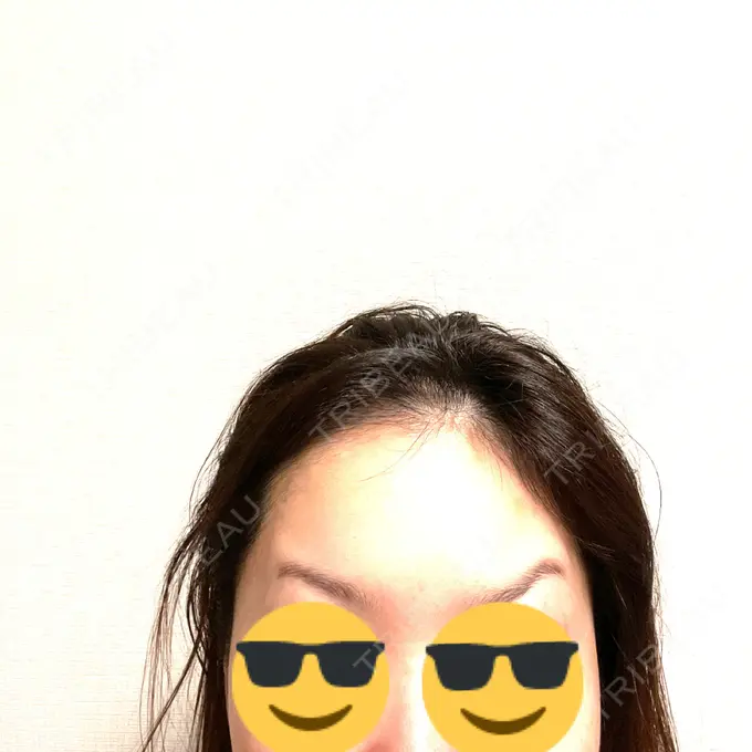 ボトックス（眉間） / ボトックス（額） 湘南美容クリニック 大阪梅田本院 AFTER メイン用