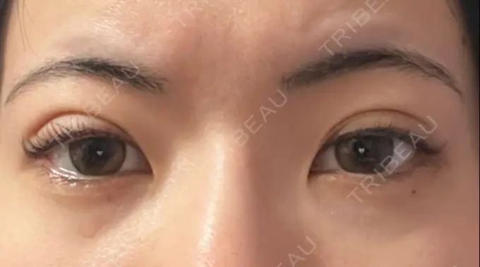 二重埋没 湘南美容クリニック 京都院 DAY 5 メイン用