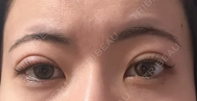 二重埋没 湘南美容クリニック 京都院 DAY 6 メイン用