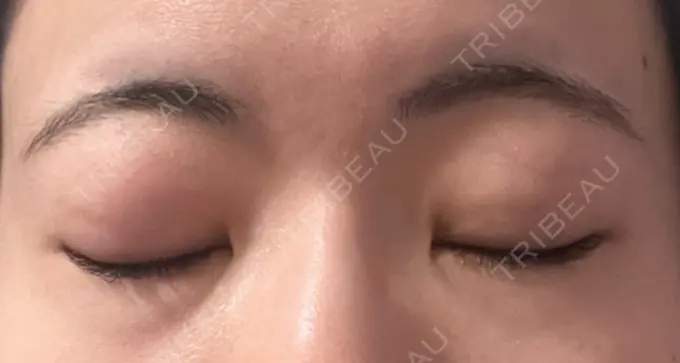 二重埋没 湘南美容クリニック 京都院 DAY 6 メイン用