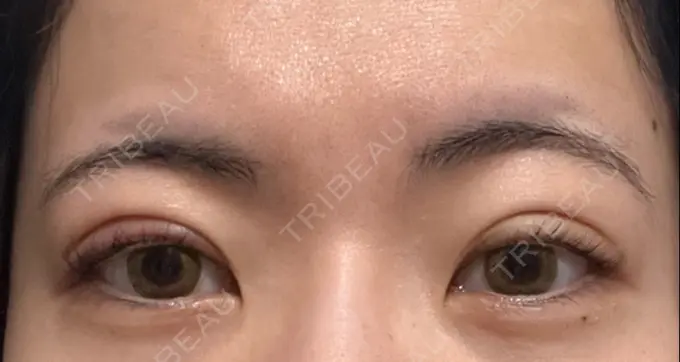 二重埋没 湘南美容クリニック 京都院 DAY 7 メイン用