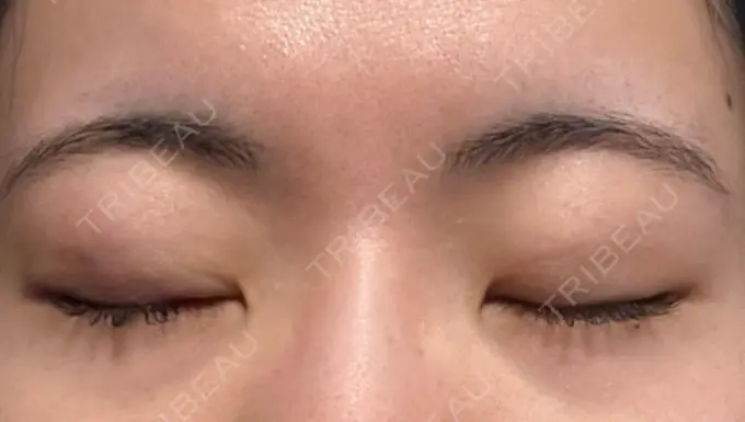 二重埋没 湘南美容クリニック 京都院 DAY 7 メイン用