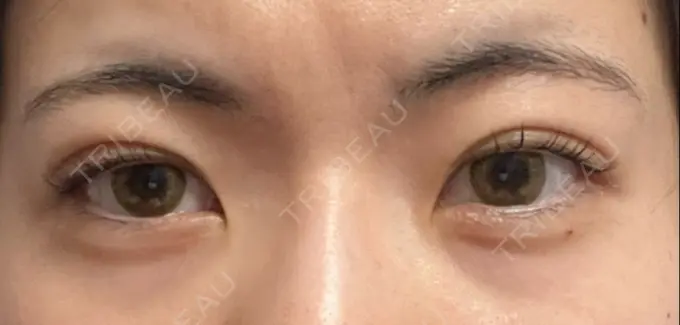 二重埋没 湘南美容クリニック 京都院 DAY 14 メイン用