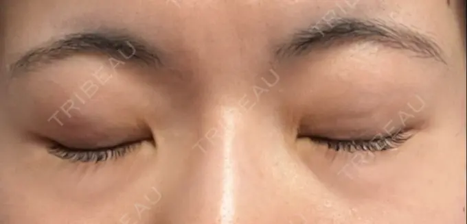 二重埋没 湘南美容クリニック 京都院 DAY 14 メイン用