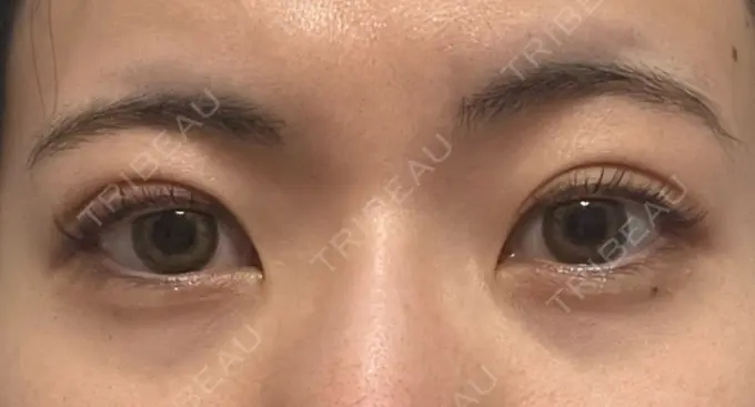 二重埋没 湘南美容クリニック 京都院 AFTER メイン用