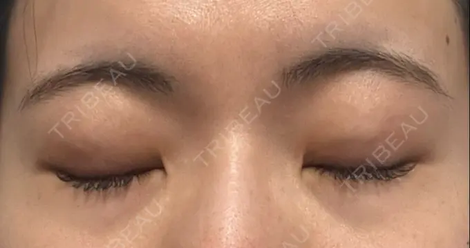 二重埋没 湘南美容クリニック 京都院 DAY 31 メイン用