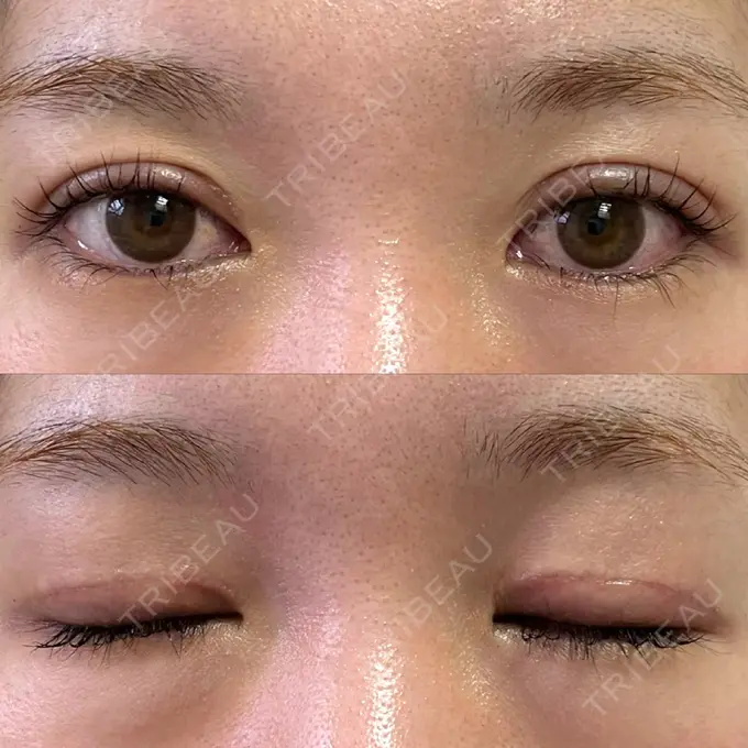 二重切開 / 上まぶたたるみ取り みずほクリニック DAY 19 メイン用