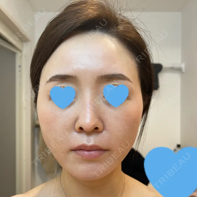 糸リフト / 脂肪吸引（顔） / メーラーファット除去 / ジョールファット除去 / ボトックス（エラ・小顔） 湘南美容クリニック 秋葉原院 AFTER メイン用