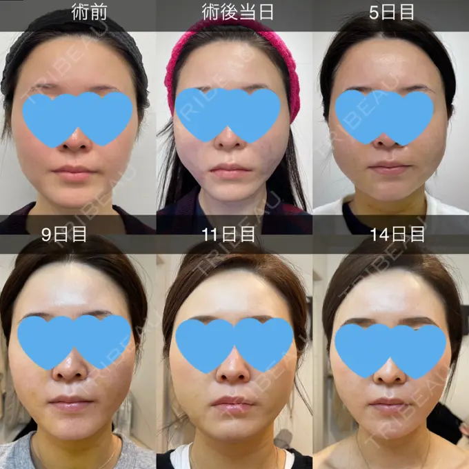 糸リフト / 脂肪吸引（顔） / メーラーファット除去 / ジョールファット除去 / ボトックス（エラ・小顔） 湘南美容クリニック 秋葉原院 DAY 13 メイン用