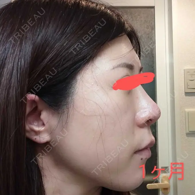 鼻尖形成（切開） / 軟骨移植 / 鼻柱下降・鼻唇角形成（猫手術） グローバルビューティークリニック 大阪院 DAY 30 メイン用