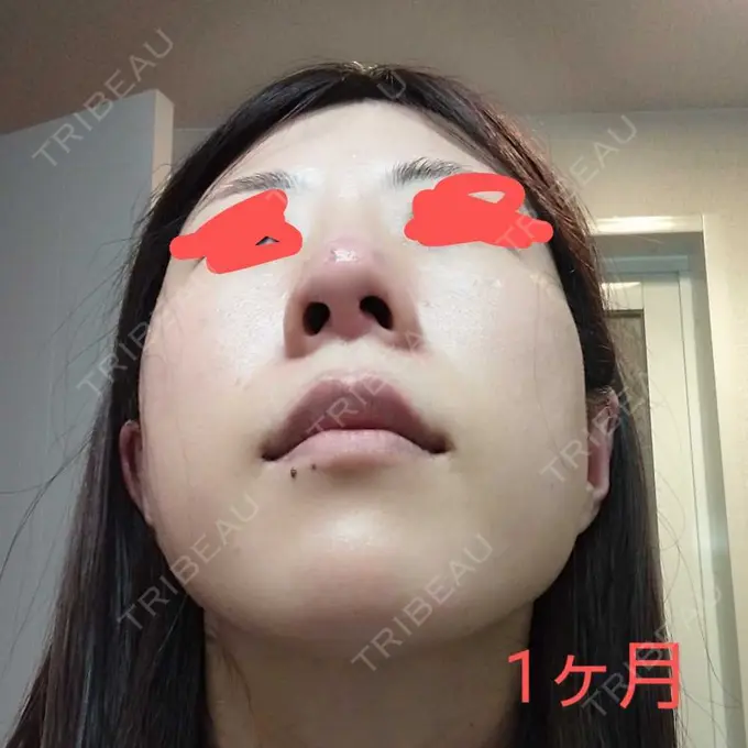 鼻尖形成（切開） / 軟骨移植 / 鼻柱下降・鼻唇角形成（猫手術） グローバルビューティークリニック 大阪院 DAY 30 メイン用