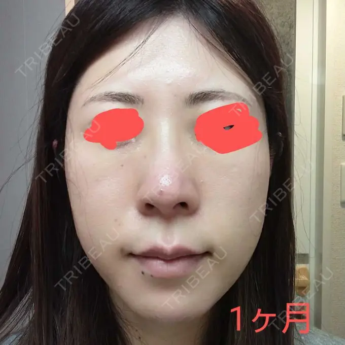 鼻尖形成（切開） / 軟骨移植 / 鼻柱下降・鼻唇角形成（猫手術） グローバルビューティークリニック 大阪院 DAY 30 メイン用