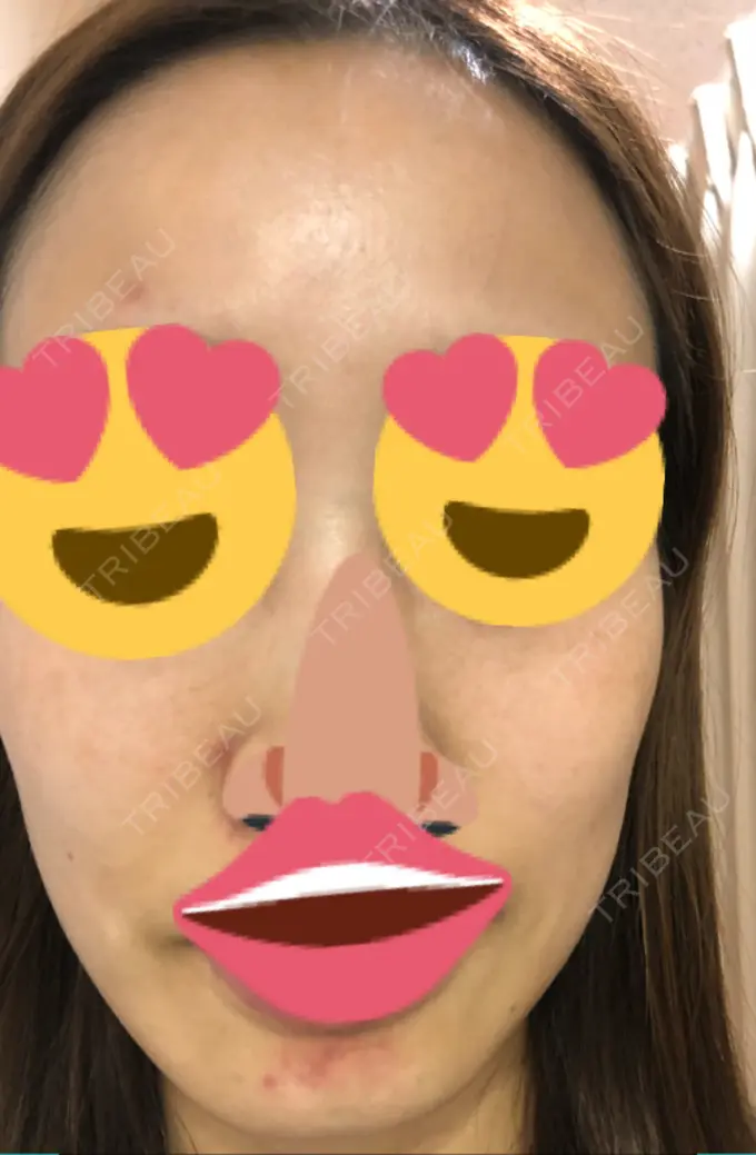 ニキビ治療 KM新宿クリニック DAY 0 メイン用