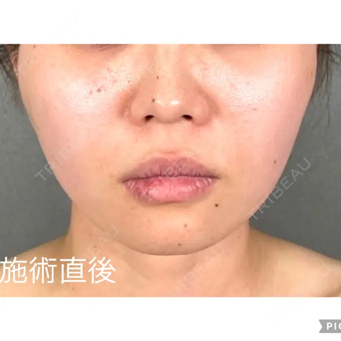 糸リフト アリエル美容クリニック 郡山院 DAY 0 メイン用