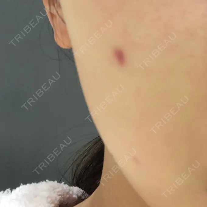 ほくろ・いぼ切除（肌） 吉祥寺アイビークリニック DAY 117 メイン用