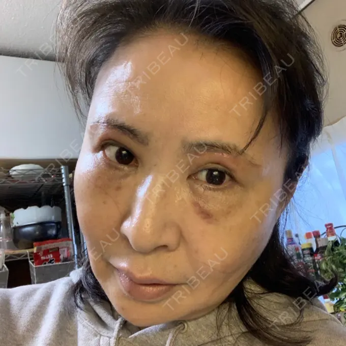 糸リフト / 下まぶたの脂肪取り / 脂肪注入（輪郭） / その他（目元） 湘南美容クリニック 橋本院 DAY 28 メイン用