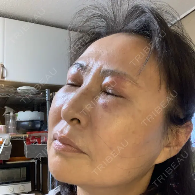 糸リフト / 下まぶたの脂肪取り / 脂肪注入（輪郭） / その他（目元） 湘南美容クリニック 橋本院 DAY 28 メイン用