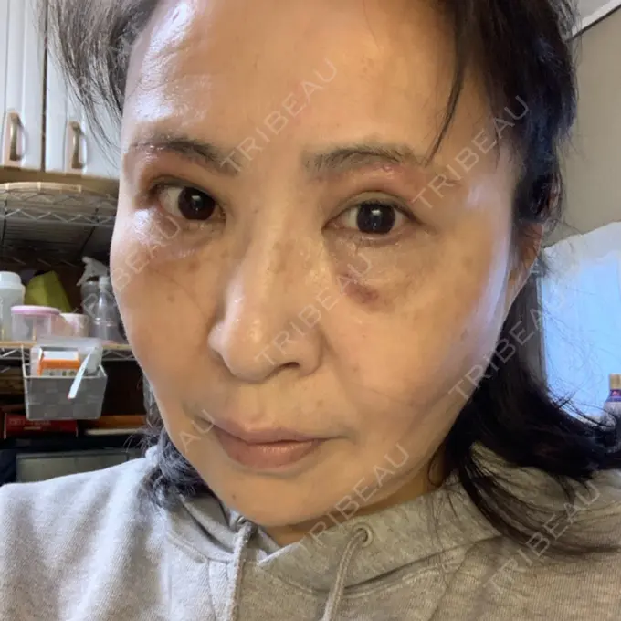 糸リフト / 下まぶたの脂肪取り / 脂肪注入（輪郭） / その他（目元） 湘南美容クリニック 橋本院 DAY 28 メイン用