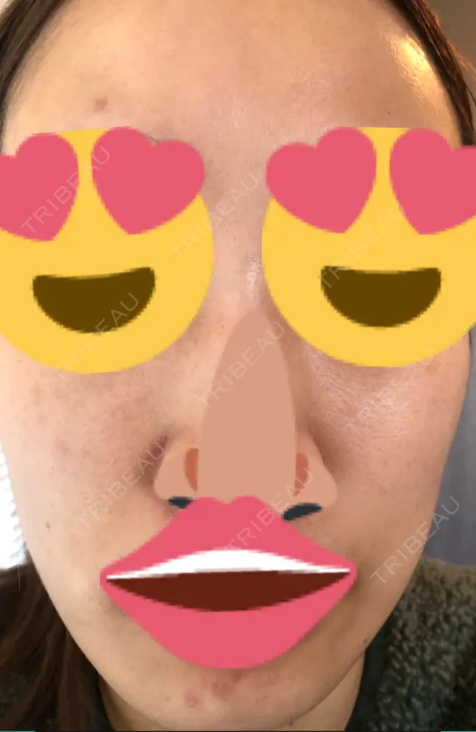 ニキビ治療 KM新宿クリニック DAY 1 メイン用