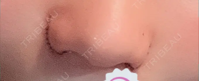 小鼻縮小（切開） 吉祥寺アイビークリニック DAY 0 メイン用