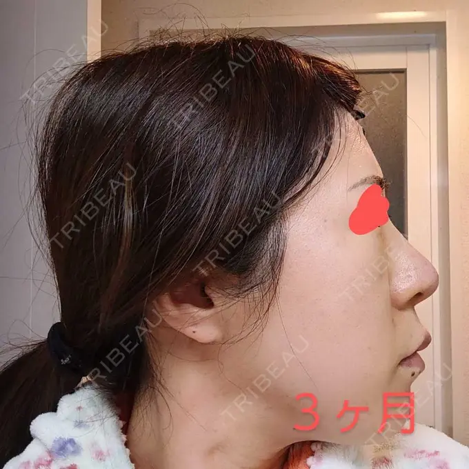 鼻尖形成（切開） / 軟骨移植 / 鼻柱下降・鼻唇角形成（猫手術） グローバルビューティークリニック 大阪院 DAY 91 メイン用