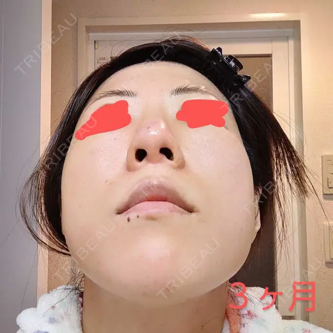 鼻尖形成（切開） / 軟骨移植 / 鼻柱下降・鼻唇角形成（猫手術） グローバルビューティークリニック 大阪院 DAY 91 メイン用