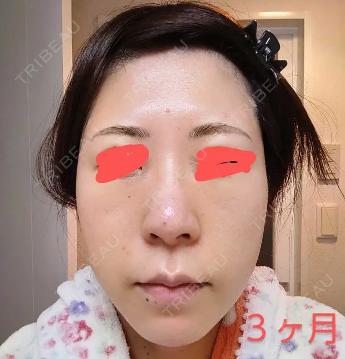 鼻尖形成（切開） / 軟骨移植 / 鼻柱下降・鼻唇角形成（猫手術） グローバルビューティークリニック 大阪院 DAY 91 メイン用