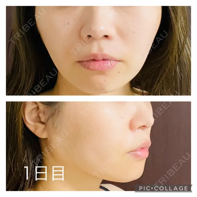 糸リフト アリエル美容クリニック 郡山院 DAY 1 メイン用