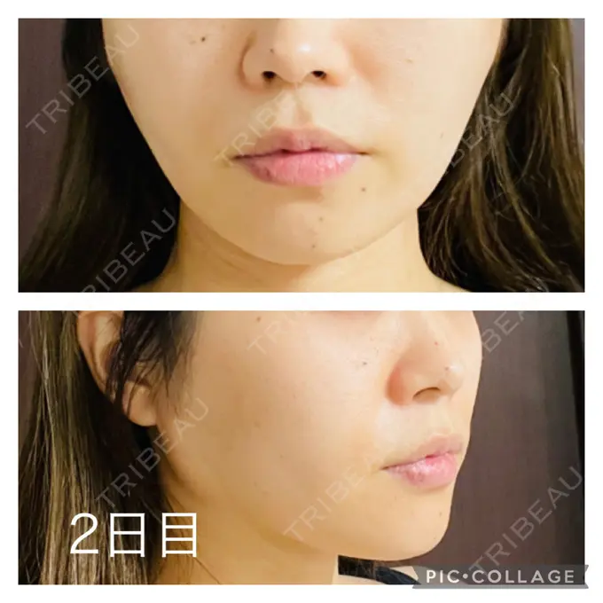 糸リフト アリエル美容クリニック 郡山院 DAY 2 メイン用