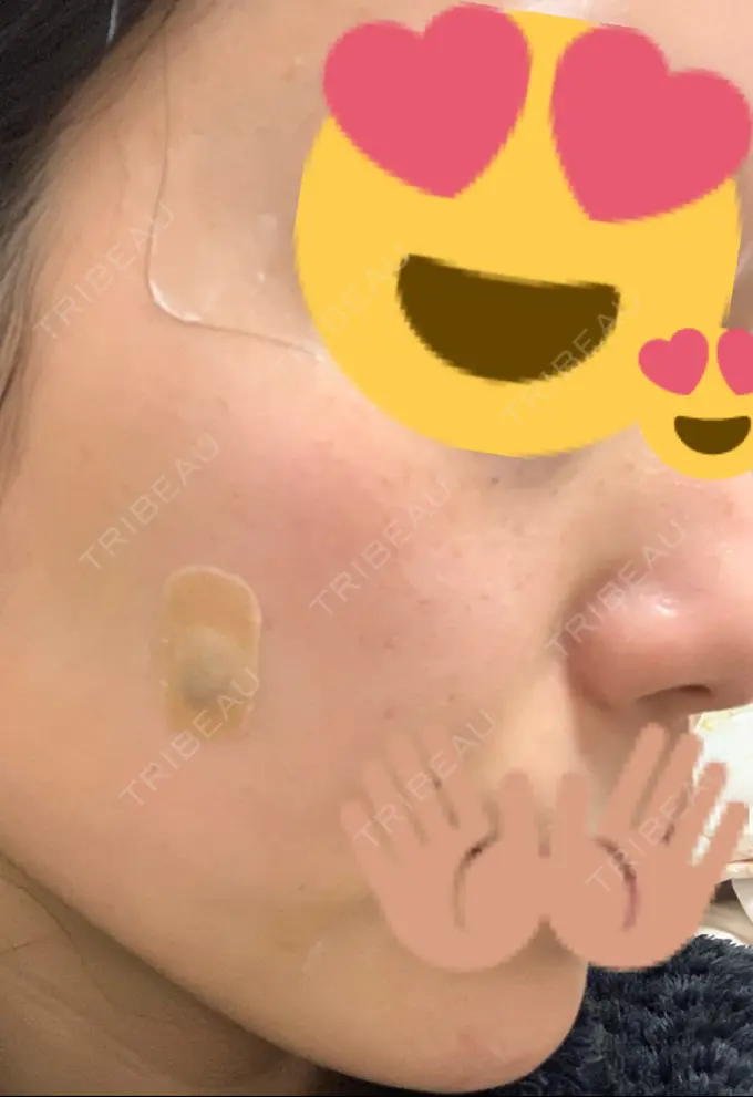 ほくろ・いぼ切除（肌） / 高濃度ビタミンC点滴 TCB東京中央美容外科 広島院 DAY 2 メイン用