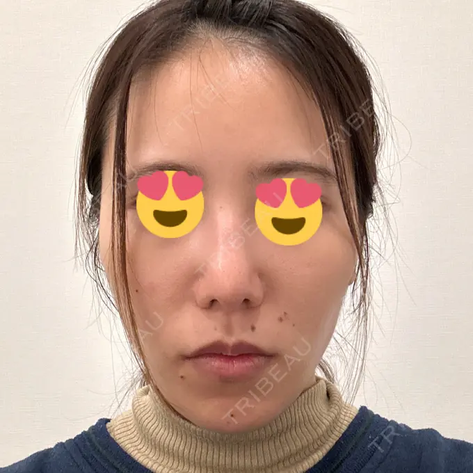 軟骨移植 / 骨切幅寄せ / ワシ鼻修正・ハンプ切除 / 鼻尖形成（非切開） 銀座マイアミ美容外科 DAY 29 メイン用