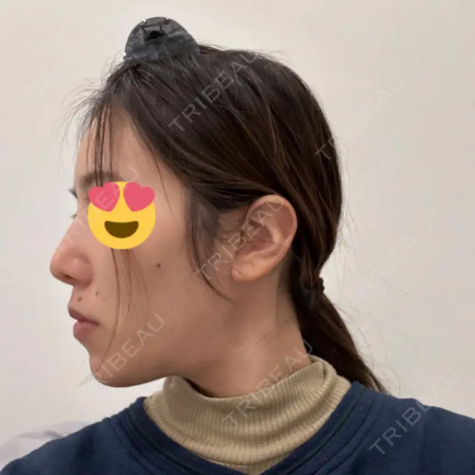 軟骨移植 / 骨切幅寄せ / ワシ鼻修正・ハンプ切除 / 鼻尖形成（非切開） 銀座マイアミ美容外科 DAY 29 メイン用