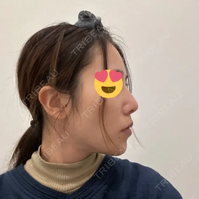 軟骨移植 / 骨切幅寄せ / ワシ鼻修正・ハンプ切除 / 鼻尖形成（非切開） 銀座マイアミ美容外科 DAY 29 メイン用