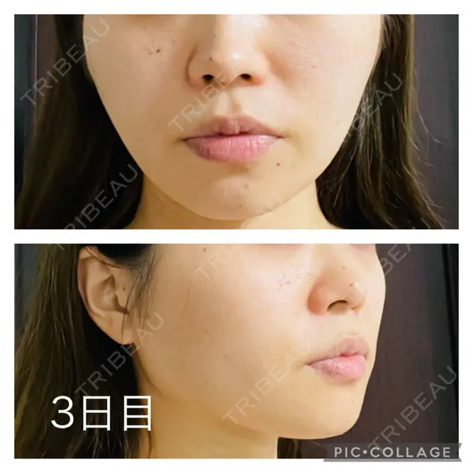 糸リフト アリエル美容クリニック 郡山院 DAY 3 メイン用