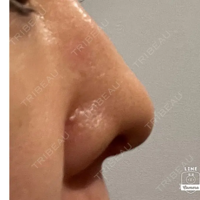 鼻尖形成（切開） / ワシ鼻修正・ハンプ切除 みずほクリニック AFTER メイン用